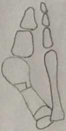 Slika 42. Distalna osteotomija prve MT kosti Roux (skica) Peabody je 1931.