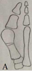 Slika 43. Distalana osteotomija prve MT kosti Peabody (skica) Druga modifikacija Reverdinove osteotomije je distalna L osteotomija, odnosno Eeverdin-Green osteotomija (slika 44) 40. Slika 44 ( A-B).