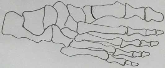 osteotomije i korekcije deformiteta, osteotomirani fragmenti se fiksiranju. Polukružna, odnosno polulučna osteotomija ne dovodi do promene dužine prve MT kosti 78 (slika 54). Slika 54.