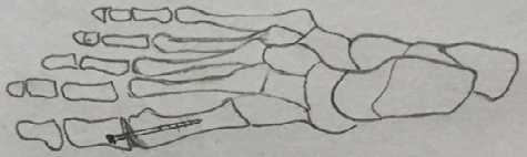 Artrodeza metatarzofalangealnog zgloba palca i metatarzokuneimformnog zgloba Ako postoji poremećena mišićna ravnoteža palca, kao što se može videti kod cerebralne paralize, kod haluks valgusa sa