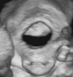 Slika Figure 3. Fetalno lice u zadnjem tromjese~ju / Fetal face in the last trimester. Tablica 1. Patolo{ke promjene u strukturi fetalna lica Table 1.