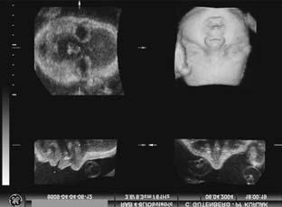 Slika 9. Multiplanarni prikaz lica 3D ultrazvukom. Figure 9. 3D ultrasound multiplanar display of the face. somije 13 ili 18 povezane s anomalijama mandibule.