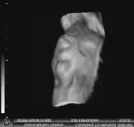 Prikaz makroglosije 3D ultrazvukom. Figure 10. 3D ultrasound presentation of macroglossy.