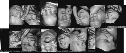 Slika 12. Razli~iti prikazi pokreta fetalnog lica. Figure 12. Various displays of fetal face movements. Slika 13. Zijevanje, pokreti ruke prema licu, pla`enje jezika. Figure 13.
