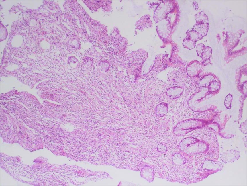 Slika 4. Broj biopsije 1615/14. Atrofija kripti sluznice debelog crijeva (HE, povećanje 100x). Bazalna plazmacitoza je najučestaliji morfološki kriterij IBD-a pronađen u 94% ispitivanih biopsija.