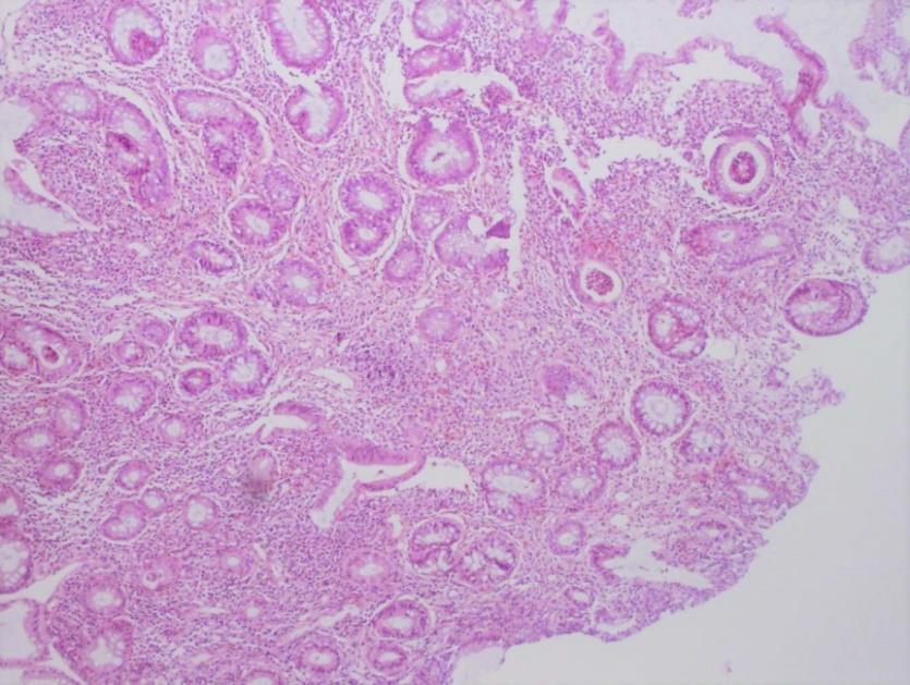 5.2.2. Učestalost sigurnih morfoloških kriterija ulceroznog kolitisa Sigurna morfološka obilježja ulceroznog kolitisa jesu difuzne abnormalnosti kripti unutar ispitivanog segmenta crijeva kao i