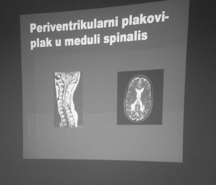 Nerv Periventrikularni plakovi- plak u meduli spinalis Simptomi Multiple Skleroze su prouzrokovani ožiljcima na centralnom nervnom sistemu i još uvijek nam nije poznato šta prouzrokuje te ožiljke.