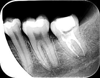 endodontskog zahvata Slika