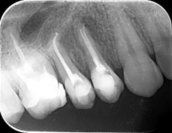 endodontskih zahvata Slika 9.