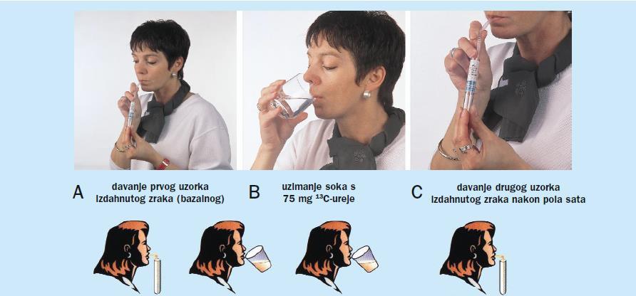 Slika 11: Način izvođenja 13C urea izdisajnog testa (preuzeto s Katičić i sur., 2002.) Njihova osjetljivost i specifičnost u većini slučajeva je veća od ostalih neinvazivnih testova.