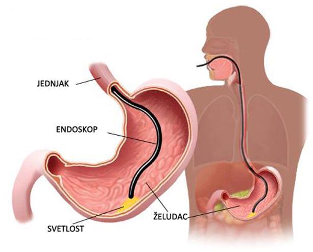 negativnih rezultata, ako uzimamo biopsiju samo antralne sluznice jer dolazi do redistribucije prema želučanom fundusu. (Katičić i sur., 2014) Slika 12.