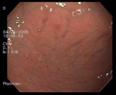 1.1. DEFINICIJA Gastritis predstavlja upalu želučane sluznice (www.medcape.com). Termin gastritis prvi puta je bio upotrjebljen 1728.