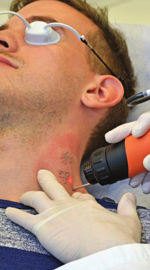 Lasersko uklanjanje tetovaža UKLANJANJE PROMJENA NA KOŽI Što je? U prosjeku, jedna od pet osoba želi ukloniti tetovažu nakon otprilike deset godina.