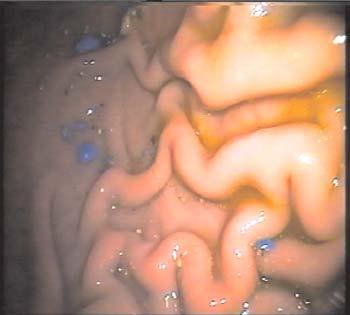 Endoscopic finding of acute gastritis (intoxication) Hroni~ni gastritis (pepti~ni ulkus) opisan je kod osam pasa: ~etiri nema~ka ov~ara, jednog zlatnog retrivera, rotvajlera, velikog {naucera i