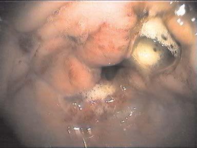 Endoskopski nalaz hroni~nog gastritisa mno{tvo ulkusa Figure 5.