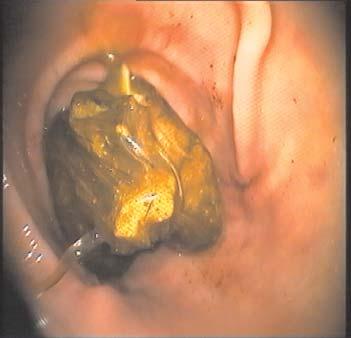 Zbog hitnosti slu~aja bio je indikovan endoskopski pregled. Endoskopskim pregledom u pilorusnom delu `eluca je zapa`ena masa nepravilnog oblika, koja je mogla da bude izvu~ena hvataljkama (slika 9).