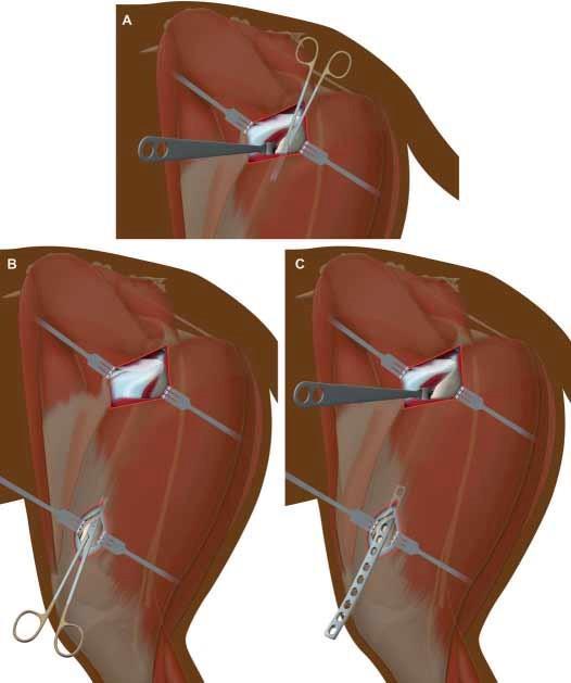 Slika 16. Prikaz MIPO pristupa bedrenoj kosti i perkutano umetanje pločice. A - tupo prepariranje u smjeru proksimalno-distalno ispod m.