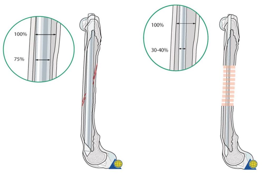 Pri postavljanju intramedularne igle u kombinaciji sa serklažom, igla mora biti deblja (70-80% širine medularnog kanala).