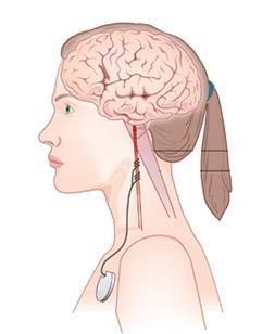 Рани систем за предикцију (лево), електрична стимулација вагусног нерва (у средини) и директна електрична стимулација мозга (десно, извор www.neuropace.