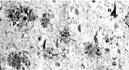 Slika 1. Nakupine amiloida β u obliku plakova (P) i hiperfosforiliranog proteina tau u obliku neurofibrilarnih snopića (N) u hipokampusu; preuzeto iz: Wippold i sur., 2008.