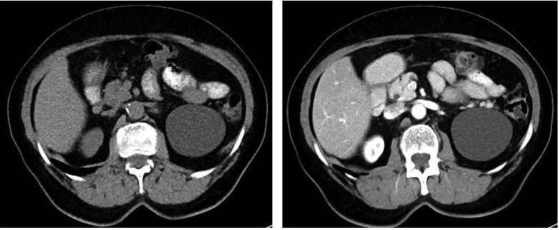 UVOD Ciste na bubrezima vrlo su čest i najčešće slučajan nalaz kod rutinskih radioloških pretraga, počevši od ultrazvuka do slikovnih metoda kompjutorizirane tomografije (CT) i magnetske rezonancije