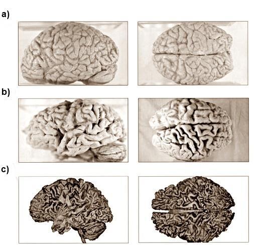 Slika 4.1. Izgled mozga a) zdrava starija osoba; b) osoba s Alzheimerovom bolešću; c) osoba oboljela od alkoholizma (16) Akutni delirij (delirium tremens) je česta akutna psihoza alkoholičara.