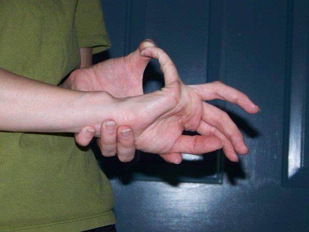 a) Hipermobilnost malog prsta na ruci Pozitivna hipermobilnost malog prsta je prisutna ako ispitanik može flektirati mali prst više od 90