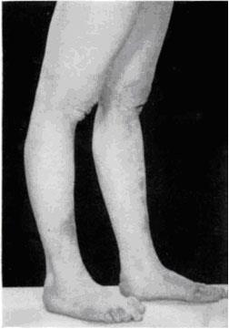 d) Hipermobilnost koljena Pozitivna hipermobilnost koljena je prisutna ako ispitanik može opružiti koljeno više od 10 stupnjeva od pune ekstenzije.