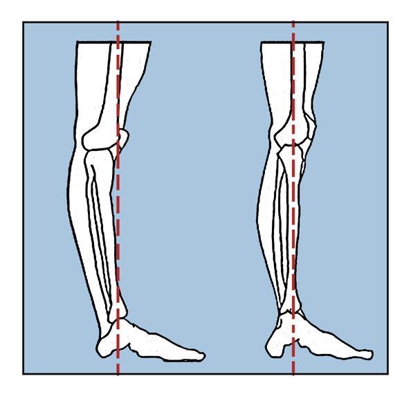 Hipermobilno koljeno (lat. genu recurvatum sabljasta noga), kao što je prije navedeno, karakterizira tzv. preopružanje koljena 10º ili više od pune ekstenzije.