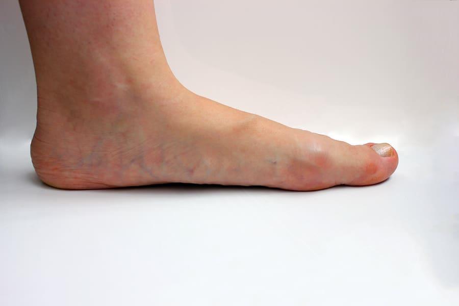 Osobito je interesantno analizirati utjecaj drugih deformacija koljena kao što su valgus koljena ili varus koljena na pojavu sindroma hipermobilnoga koljena tj.