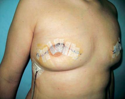 Kompresivni grudnjak pacijentice nose 6 tjedana, 24 sata dnevno. Kod rekonstrukcije vlastitim tkivom s trbuha, postavlja se elastični pojas oko trbuha koji se također nosi 6 tjedana.